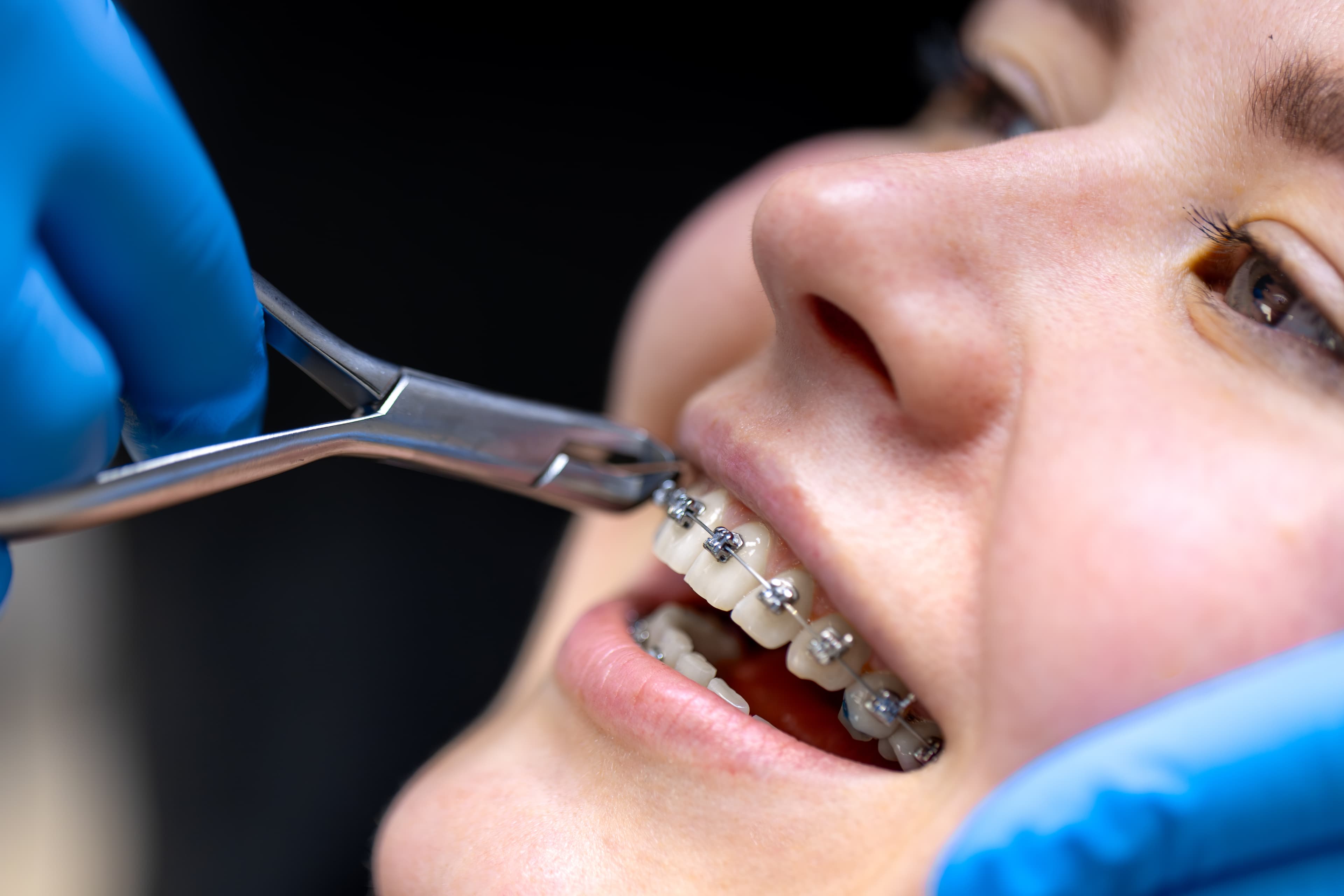 Braces removal service